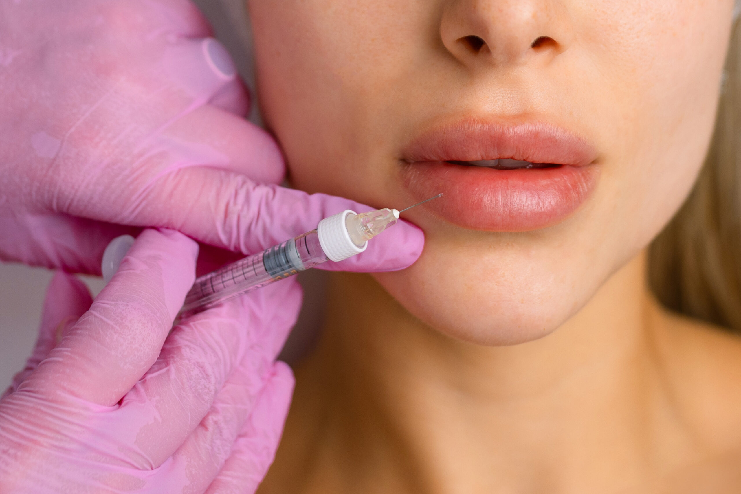 Lip Fillers In Lakewood Ranch, Fl Lip Fillers in Lakewood Ranch, FL
