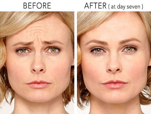 Botox before after female