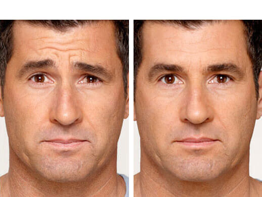 Botox before after male 1b