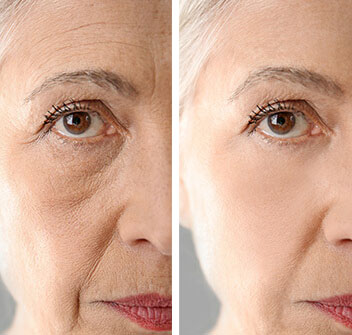 botox 103