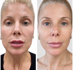 before after smooth it out
